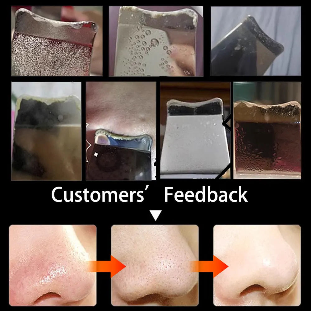Electric Blackhead Remover